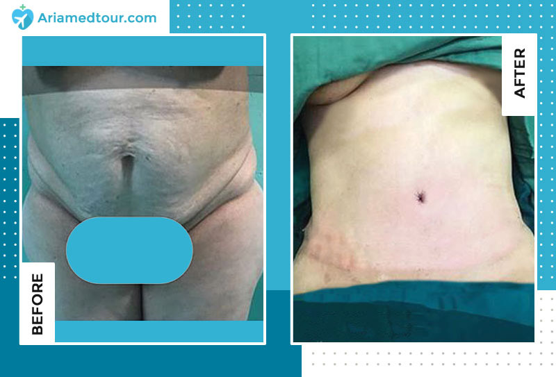 Reclaim Your Pre-Pregnancy Body: Tummy Tuck After Pregnancy - Peninsula  Plastic Surgery