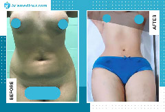 Reclaim Your Pre-Pregnancy Body: Tummy Tuck After Pregnancy - Peninsula  Plastic Surgery