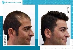 Hair Transplant in Iran | Best Surgeons & Clinics | AriaMedTour