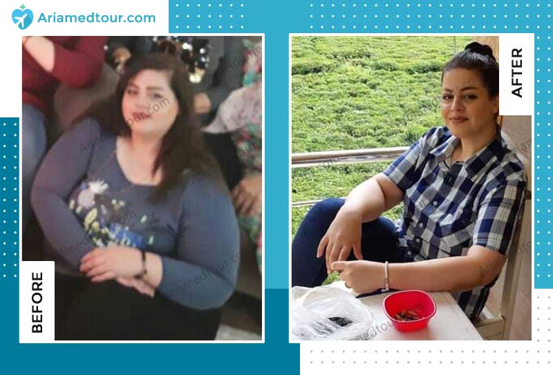 weight loss before after dr. shahriar azizi