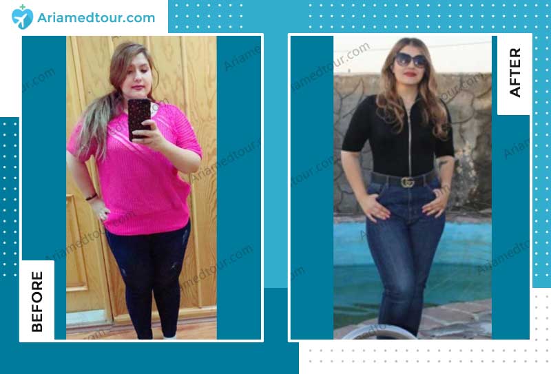 weight loss before after dr. shahriar azizi