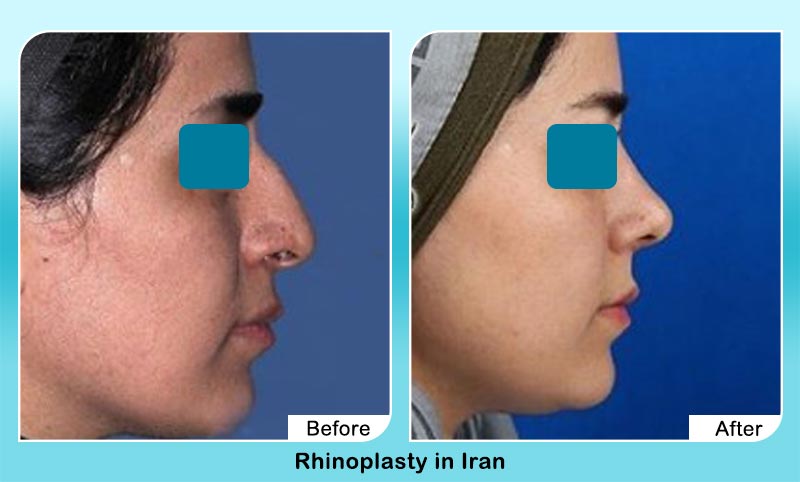 before and after nose job in Iran with Dr. Hamidreza Hosnani