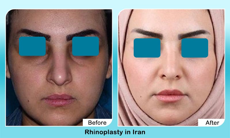before and after nose job in Iran with Dr. Hosnani