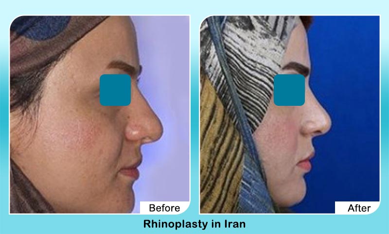 before and after rhinoplasty with Dr. Hamidreza Hosnani