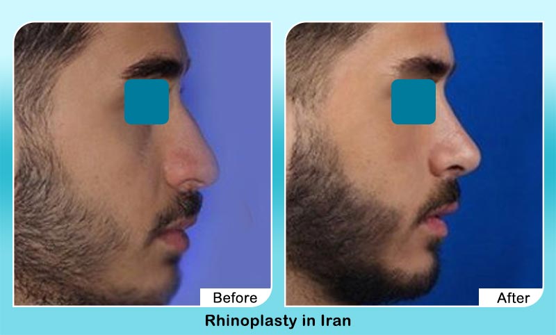 before and after nose job in Iran for men with Dr. Hamidreza Hosnani