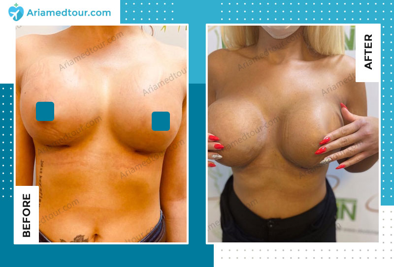 Before and after breast augmentation in Iran with Dr. Azizi
