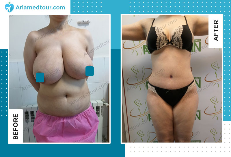 Before and after breast reduction in Iran with Dr. Azizi