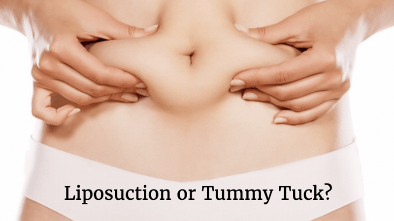liposuction vs tummy tuck