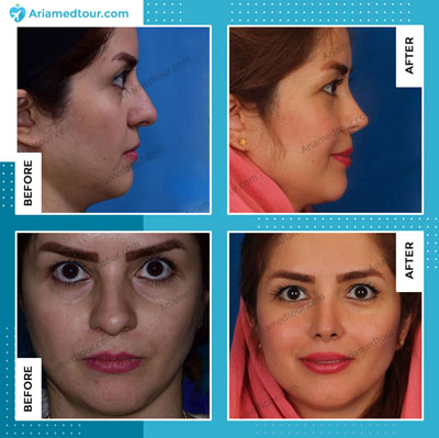 rhinoplasty nose job before after photo in iran