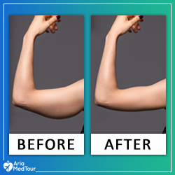 Arm Lift Before and After Photos (2022) - Iran | AriaMedTour