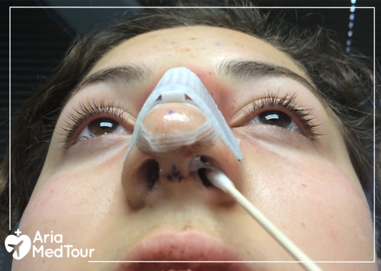 Cleaning nose after rhinoplasty Why, when & how? AriaMedTour