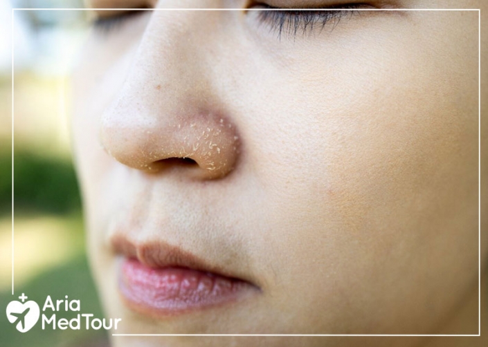 Skin Care After Rhinoplasty; All You Need to Know AriaMedTour