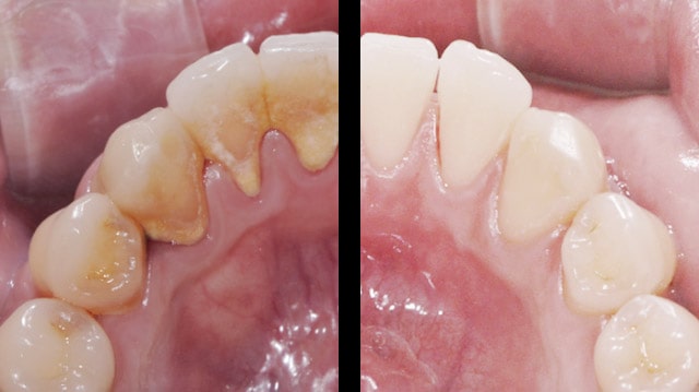 before and after dental scaling and root planing