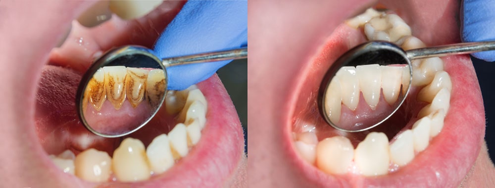 dental scaling and root planing before after