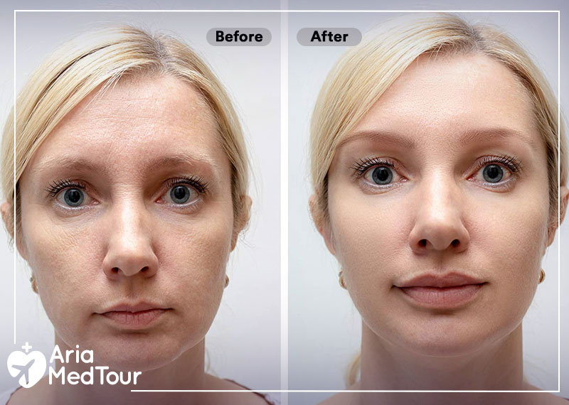 before and after result of Botox and fillers injection