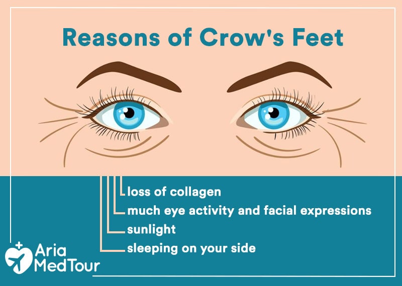 an infographic showing the reasons and causes of crow's feet