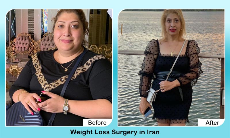 Dr Mehdi Yamini gastric balloon before and after photo