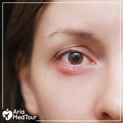 Discharge after chalazion surgery