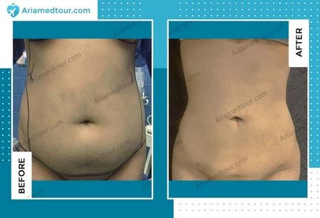 Patient 133820252  Non-Surgical BBL Before & After Photos
