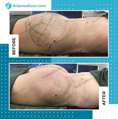 Before And After Bbl (Brazillian Butt Lift) Surgery Photos