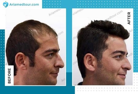 hair transplant before after Iran