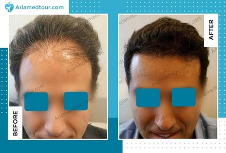 Iran hair transplant before after photo