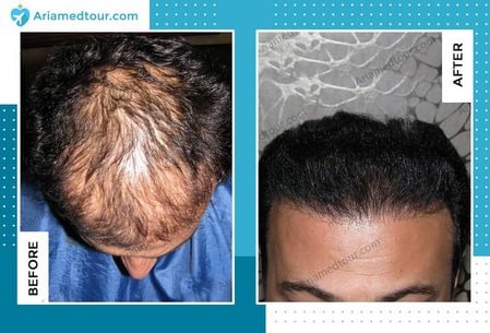 hair transplant before after photo
