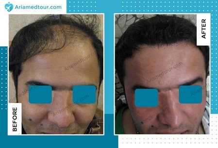 hair transplant before after photo Iran