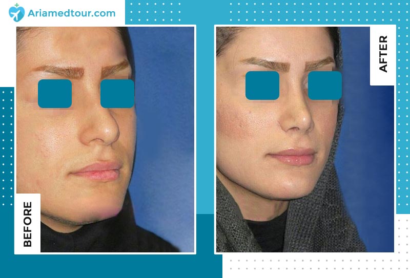 nose job before after photo by dr. Farzan Rezaei