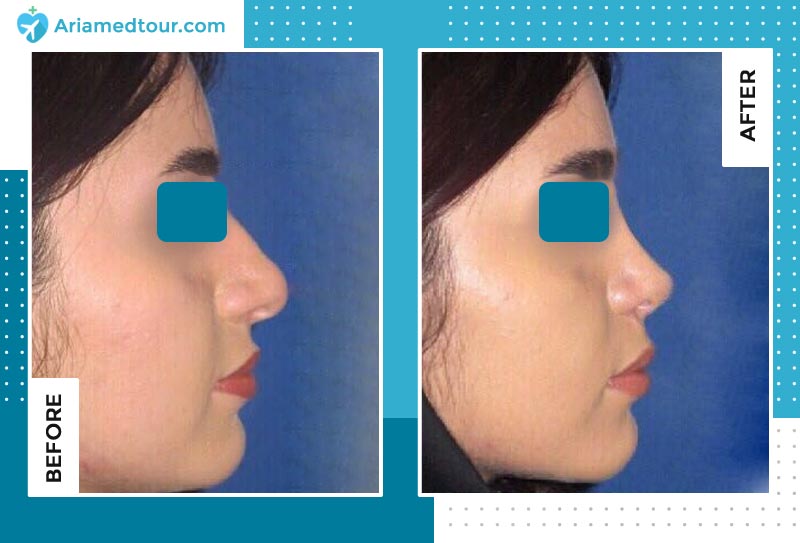 nose job before after photo by dr. Farzan Rezaei