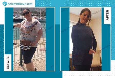 Iran weight loss surgery before and after photo