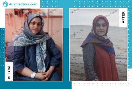 Iran weight loss surgery before and after photo