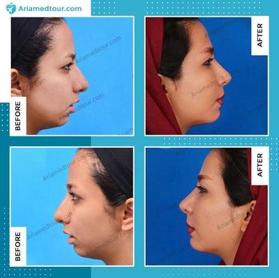 chin augmentation surgery before after in Iran