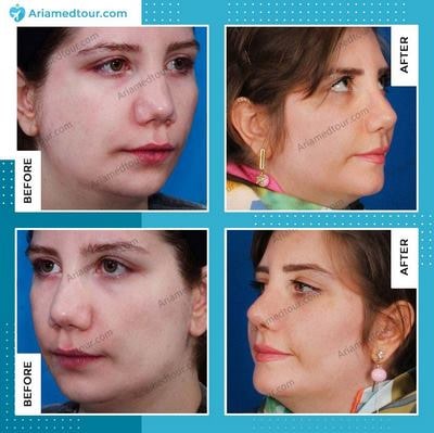 chin augmentation in Iran before after
