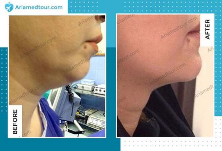 chin surgery in iran before and after
