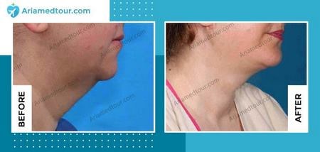 double chin surgery before and after in Iran