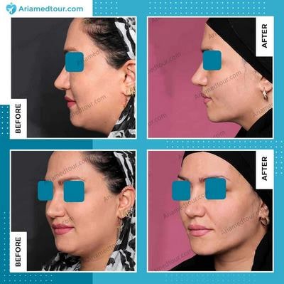 double chin surgery before and after in Iran