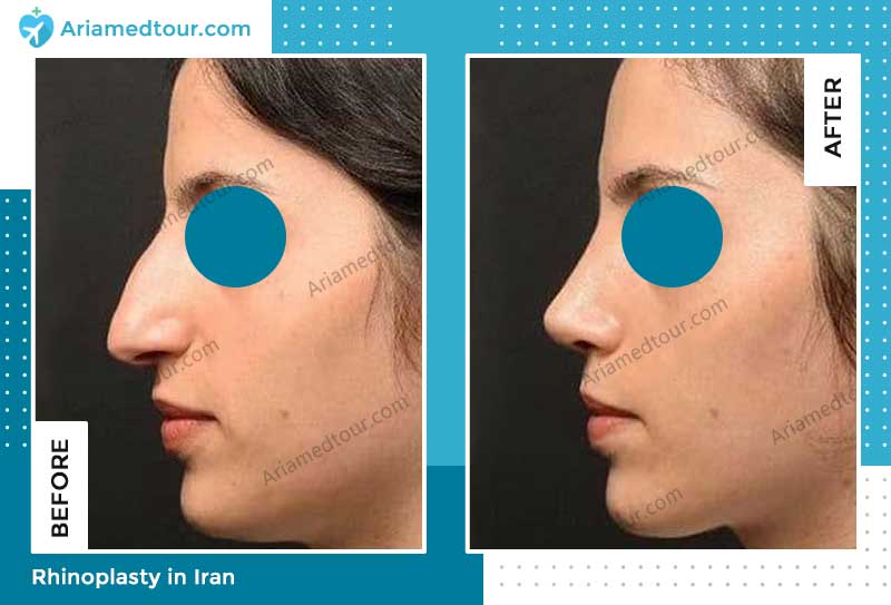 nose job surgery before and after photo by Dr. Astaraki