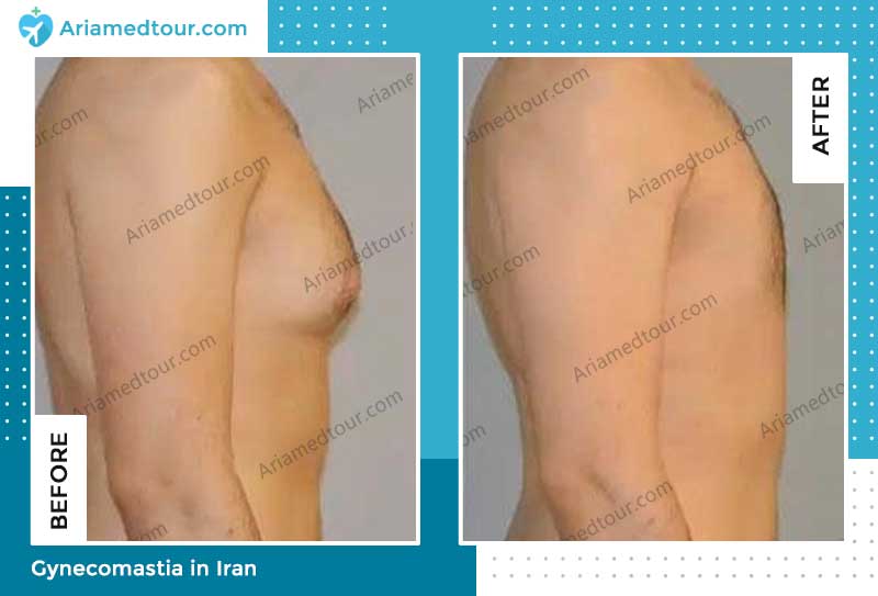 gynecomastia before and after photo by Dr. Vahab Astaraki