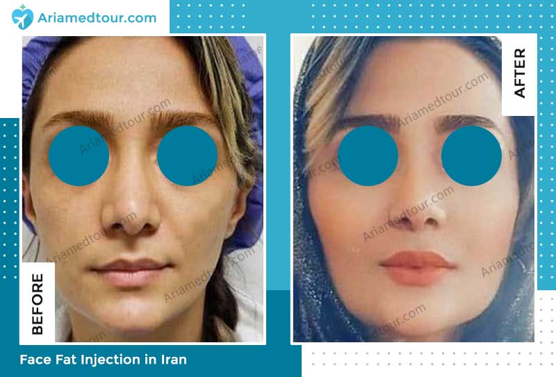 nose job before and after photo by Dr. Vahab Astaraki