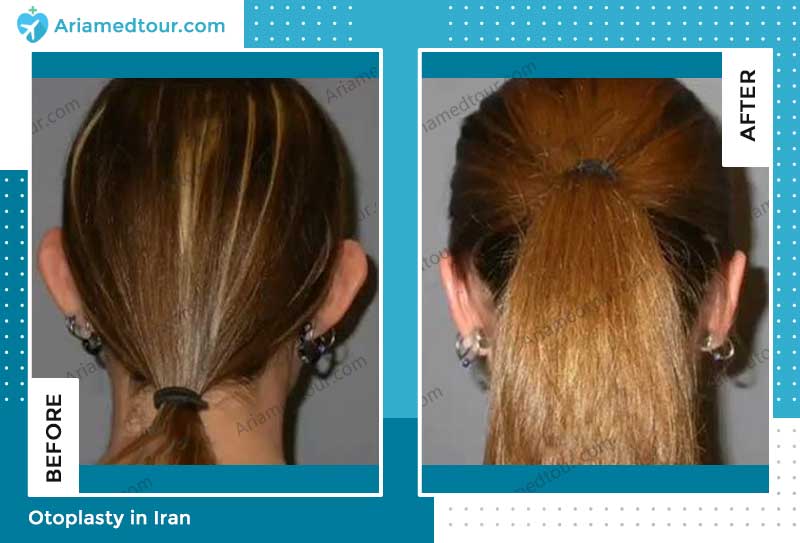 ear surgery before and after photo by Dr. Vahab Astaraki