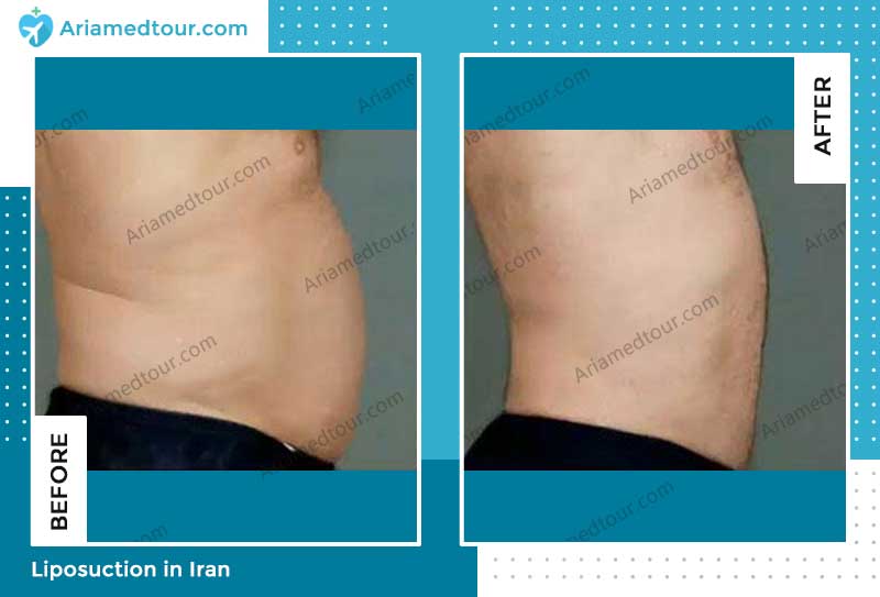 male breast reduction before and after photo by Dr. Vahab Astaraki