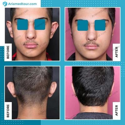 ear surgery (otoplasty) before after photo in Iran