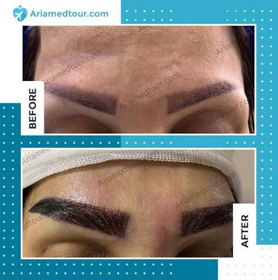 eyebrow transplant before and after photo