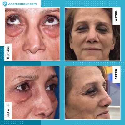Eyelid Surgery (Blepharoplasty) before and after photo in Iran