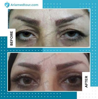 Blepharoplasty before and after photo in Iran