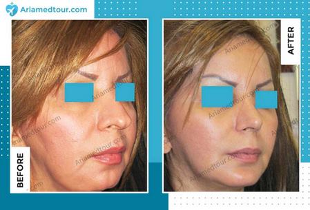 face lift before and after photo