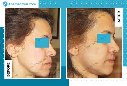 face lift surgery before and after photo in Iran