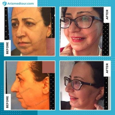 face lift before and after in Iran