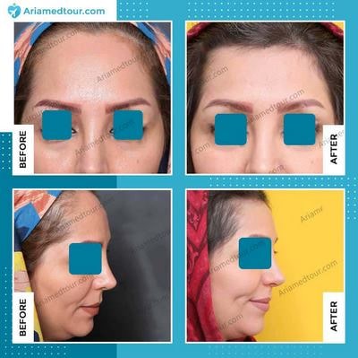 forehead contouring before and after photo
